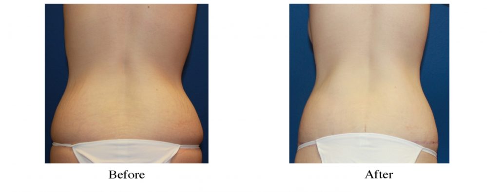 Lower Body Lift Surgery in Culver City, CA