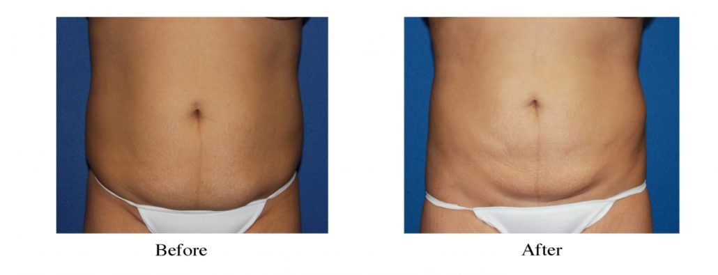 Smart Lipo Abs and Flanks - Tri-Cities - Kennewick, Pasco, and